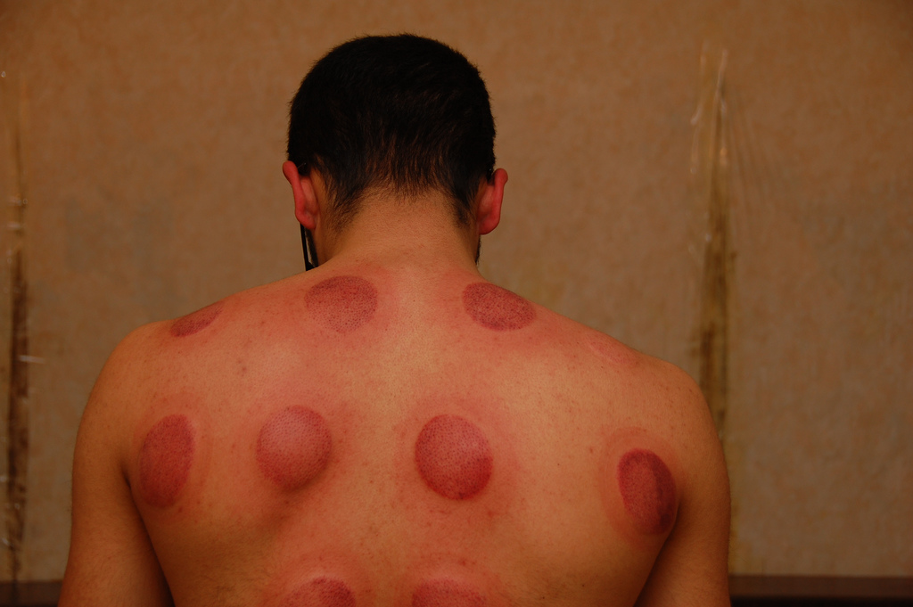 Why Olympians and Celebrities Endorse Cupping
